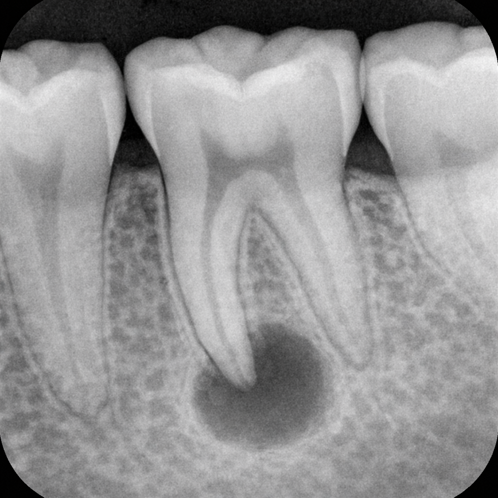 염증 제어 상태
