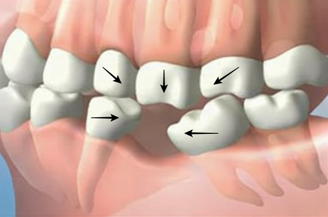 인접 치아 쓰러짐