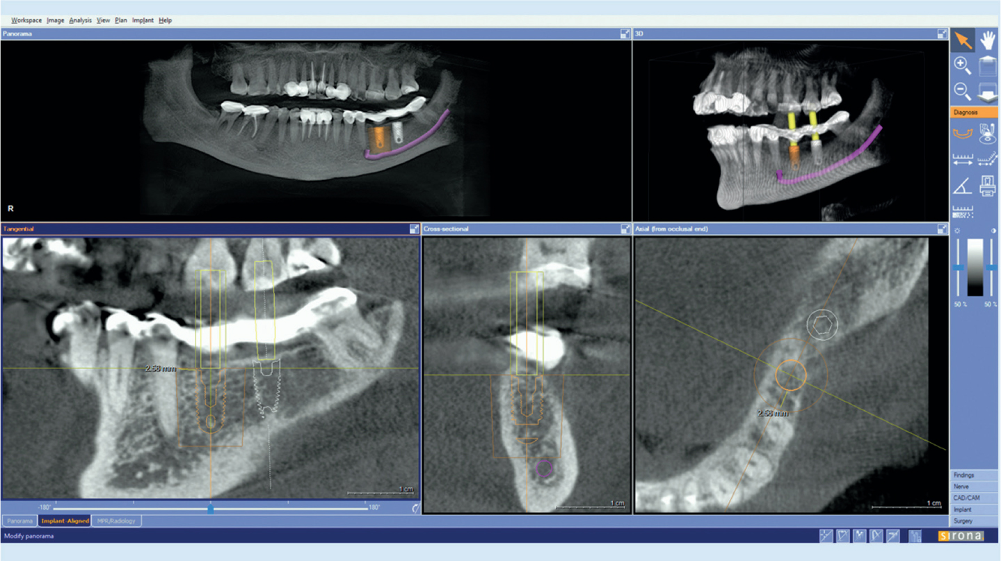 3D CT 골량 정밀 계측