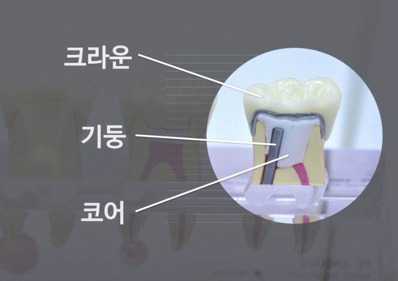 포스트 코어 필요성 판단