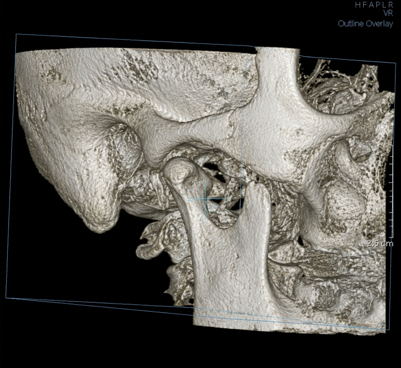 턱관절 MRI CBCT 영상 검사 기준