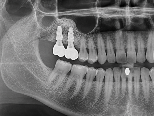 상악동 파노라마 이미지